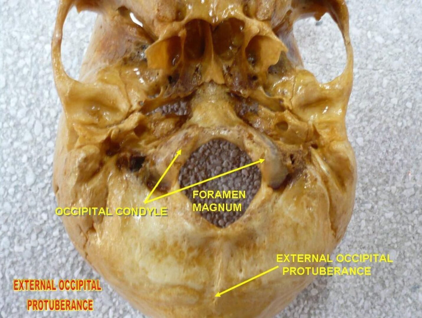 External occipital protuberance External occipital protuberance